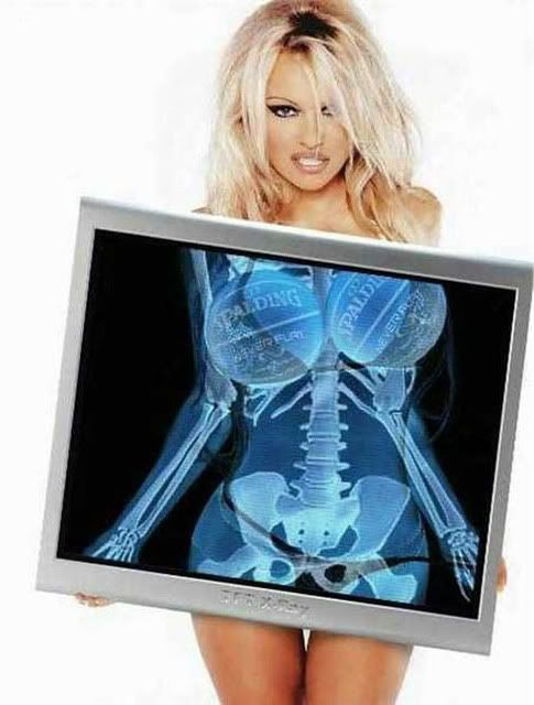 Pam_Anderson_s_X-ray.jpg