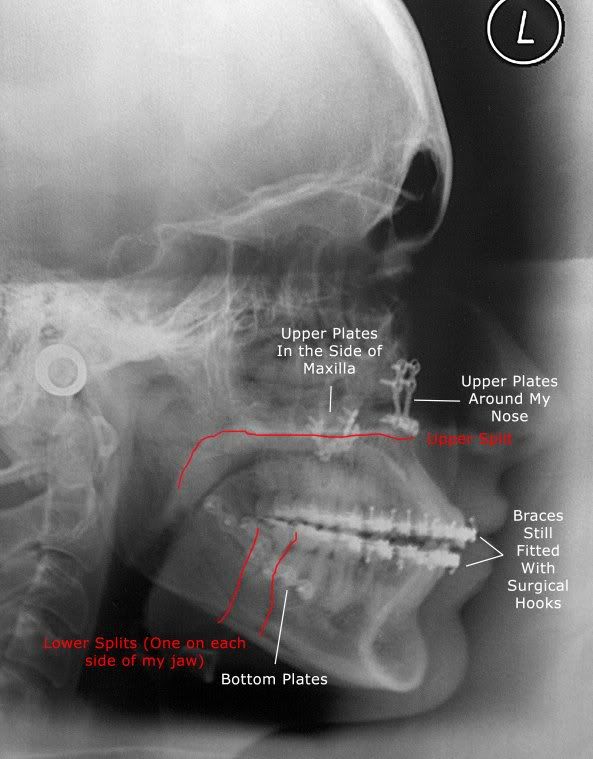 Vibrating Plates When Blowing Your Nose? Metal Mouth Message Board